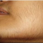 MASKA OD OVE BILJKE UKLANJA SVE DLAKE SA LICA ZAUVIJEK: Brzo zapišite RECEPT, poslije ovog dlake više ne rastu