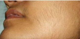 MASKA OD OVE BILJKE UKLANJA SVE DLAKE SA LICA ZAUVIJEK: Brzo zapišite RECEPT, poslije ovog dlake više ne rastu