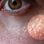 NI SLUČAJNO IH NE ISTISKUJTE, IMATE LI OVE BIJELE TAČKICE NA LICU? Uklanjaju se jednstavno, TREBAJU VAM 3 SASTOJKA KOJA IMATE U KUĆI