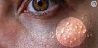 NI SLUČAJNO IH NE ISTISKUJTE, IMATE LI OVE BIJELE TAČKICE NA LICU? Uklanjaju se jednstavno, TREBAJU VAM 3 SASTOJKA KOJA IMATE U KUĆI