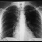 PULMOLOG MIODRAG OTKRIO KOJI JE NAJBOLJI LIJEK ZA UPALU PLUĆA: Ove 2 stvari zajedno su bolje i od antibiotika