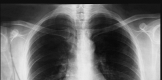 PULMOLOG MIODRAG OTKRIO KOJI JE NAJBOLJI LIJEK ZA UPALU PLUĆA: Ove 2 stvari zajedno su bolje i od antibiotika