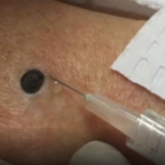 ŽENA JE GAJILA OVO NA LEĐIMA: Kada je doktorka uzela špric i bocnula, shvatit ćete zašto je SNIMAK pregledalo 33 miliona ljudi!