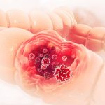 Kako najbrže prepoznati rak debelog creva: Ovo je najčešći simptom, ako ga zanemarite, u velikoj ste opasnosti