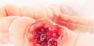 Kako najbrže prepoznati rak debelog creva: Ovo je najčešći simptom, ako ga zanemarite, u velikoj ste opasnosti