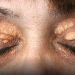 Ako vam se u blizini očiju pojavilo masno tkivo: Nipošto nemojte ga stiskati, morate učiniti sledeće da nestane! (Foto)