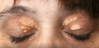 Ako vam se u blizini očiju pojavilo masno tkivo: Nipošto nemojte ga stiskati, morate učiniti sledeće da nestane! (Foto)
