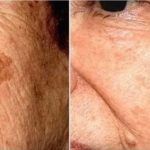 POZNATI DERMATOLOG OTKRIO: Ovo je uloga sode bikarbone u liječenju mrlja na licu!