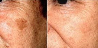 POZNATI DERMATOLOG OTKRIO: Ovo je uloga sode bikarbone u liječenju mrlja na licu!