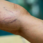 Otkrijte Moć Prirodnih Lijekova za Otekline i Proširene Vene