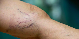 Otkrijte Moć Prirodnih Lijekova za Otekline i Proširene Vene