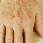 Staračke pjege i flekice na koži su prošlost uz ovaj ayuverdski recept