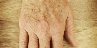 Staračke pjege i flekice na koži su prošlost uz ovaj ayuverdski recept