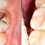 ZBOG OVE STRAŠNE BAKTERIJE VAM SMRDI IZ USTA: Samo JEDAN TRIK je potreban da to nestane, IZ USTA ĆE VAM MIRISATI RUŽE!