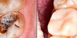 ZBOG OVE STRAŠNE BAKTERIJE VAM SMRDI IZ USTA: Samo JEDAN TRIK je potreban da to nestane, IZ USTA ĆE VAM MIRISATI RUŽE!