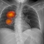 Ljekari upozorili: Ovo je pet uzročnika karcinoma