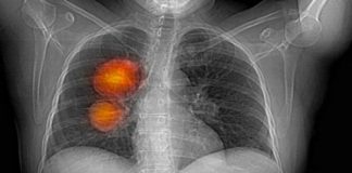 Ljekari upozorili: Ovo je pet uzročnika karcinoma