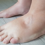 Kako Izbaciti Višak Vode iz Tijela: Prirodni Načini za Smanjenje Oticanja