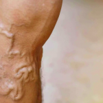 Prirodni Recept Protiv Bolova u Nogama: Rješenje za Proširene Vene i Oticanje