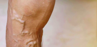 Prirodni Recept Protiv Bolova u Nogama: Rješenje za Proširene Vene i Oticanje