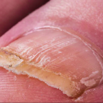 Prirodni Lijekovi za Gljivice na Noktima: Isprobani Recepti i Savjeti