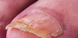 Prirodni Lijekovi za Gljivice na Noktima: Isprobani Recepti i Savjeti