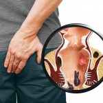 Prijeki lijek za bakterije u želucu, hemoroide i crijevna oboljenja