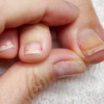 Najbolji Savjeti za Liječenje Uraslog Nokta: Brzo Olakšanje uz Prirodne Metode