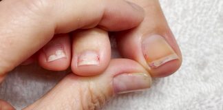 Najbolji Savjeti za Liječenje Uraslog Nokta: Brzo Olakšanje uz Prirodne Metode