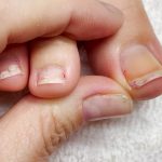 Najbolji Savjeti za Liječenje Uraslog Nokta: Brzo Olakšanje uz Prirodne Metode