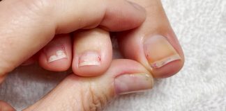 Najbolji Savjeti za Liječenje Uraslog Nokta: Brzo Olakšanje uz Prirodne Metode