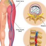 OTKLJEŠTITE UKLJEŠTENI ŽIVAC U LUMBALNOM DIJELU: Dva jednostavna koraka I BOL ZAUVIJEK NESTAJE!