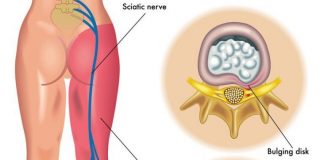 OTKLJEŠTITE UKLJEŠTENI ŽIVAC U LUMBALNOM DIJELU: Dva jednostavna koraka I BOL ZAUVIJEK NESTAJE!