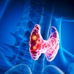 Uticaj Hrane na Štitnu Žlijezdu: Namirnice koje Treba Izbjegavati