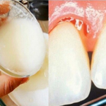 SKINITE KAMENAC I UNIŠTITE BAKTERIJE U USTIMA SA SAMO JEDNIM SASTOJKOM (RECEPT)