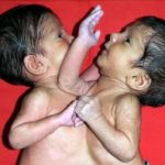 Maja je rodila ćerke spojene srcem i ostavila ih u bolnici: Sudbina sijamskih bliznakinja podigla celu naciju na noge, a kad su ih razdvojili usledio pakao Maja je rodila ćerke spojene srcem i ostavila ih u bolnici: Sudbina sijamskih bliznakinja podigla celu naciju na noge, a kad su ih razdvojili usledio pakao - featured image