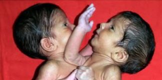 Maja je rodila ćerke spojene srcem i ostavila ih u bolnici: Sudbina sijamskih bliznakinja podigla celu naciju na noge, a kad su ih razdvojili usledio pakao Maja je rodila ćerke spojene srcem i ostavila ih u bolnici: Sudbina sijamskih bliznakinja podigla celu naciju na noge, a kad su ih razdvojili usledio pakao - featured image