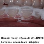 Domaći recept : Kako da UKLONITE kamenac, upalu desni i izbijelite zube u samo 4 koraka!