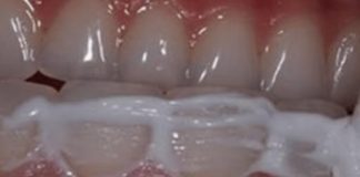 Domaći recept : Kako da UKLONITE kamenac, upalu desni i izbijelite zube u samo 4 koraka!