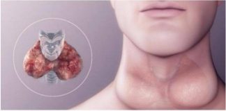 Umor, debljanje i tuga. Ukoliko osjetite PROMJENE u sebi zajedno sa NOVOTKRIVENIM simptomima problema sa štitnom žlijezdom, NEMOJTE IH IGNORISIRATI! Umor, debljanje i tuga. Ukoliko osjetite PROMJENE u sebi zajedno sa NOVOTKRIVENIM simptomima problema sa štitnom žlijezdom, NEMOJTE IH IGNORISIRATI! - featured image