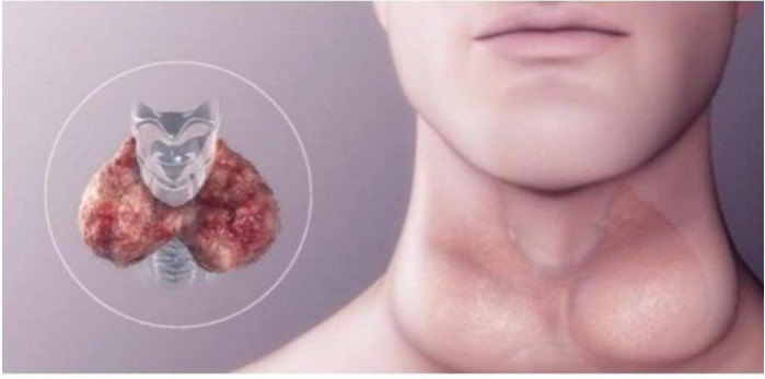 Umor, debljanje i tuga. Ukoliko osjetite PROMJENE u sebi zajedno sa NOVOTKRIVENIM simptomima problema sa štitnom žlijezdom, NEMOJTE IH IGNORISIRATI! - featured image Umor, debljanje i tuga. Ukoliko osjetite PROMJENE u sebi zajedno sa NOVOTKRIVENIM simptomima problema sa štitnom žlijezdom, NEMOJTE IH IGNORISIRATI! - featured image