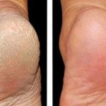 ZA MEKA STOPALA POTREBNA SU VAM SAMO 3 SASTOJKA IZ KUHINJE: Potopite noge u ovu smjesu na 15 minuta i recite zbogom ispucalim petama ZA MEKA STOPALA POTREBNA SU VAM SAMO 3 SASTOJKA IZ KUHINJE: Potopite noge u ovu smjesu na 15 minuta i recite zbogom ispucalim petama - featured image