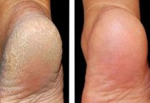 ZA MEKA STOPALA POTREBNA SU VAM SAMO 3 SASTOJKA IZ KUHINJE: Potopite noge u ovu smjesu na 15 minuta i recite zbogom ispucalim petama ZA MEKA STOPALA POTREBNA SU VAM SAMO 3 SASTOJKA IZ KUHINJE: Potopite noge u ovu smjesu na 15 minuta i recite zbogom ispucalim petama - featured image