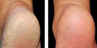 ZA MEKA STOPALA POTREBNA SU VAM SAMO 3 SASTOJKA IZ KUHINJE: Potopite noge u ovu smjesu na 15 minuta i recite zbogom ispucalim petama ZA MEKA STOPALA POTREBNA SU VAM SAMO 3 SASTOJKA IZ KUHINJE: Potopite noge u ovu smjesu na 15 minuta i recite zbogom ispucalim petama - featured image